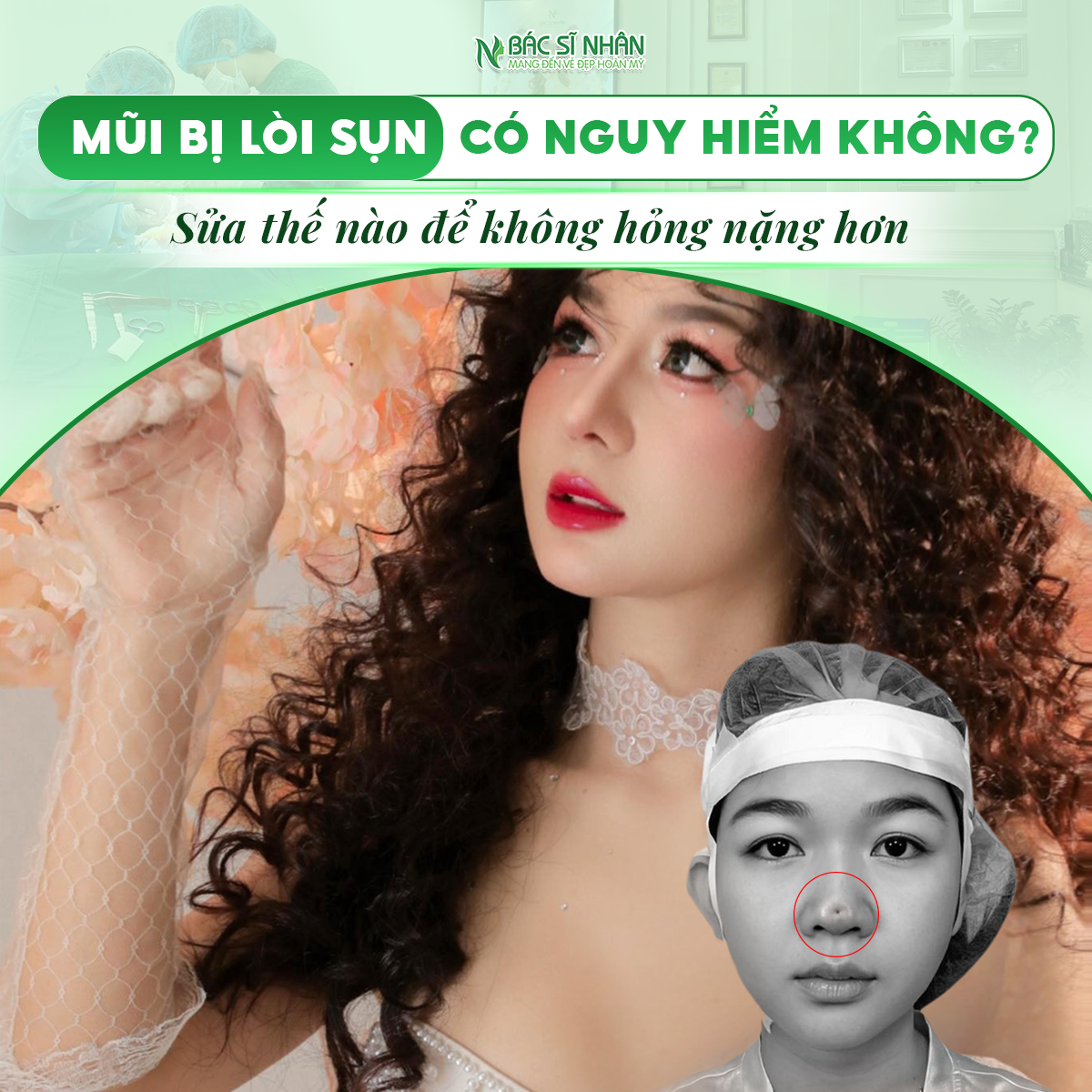 MŨI BỊ LÒI SỤN - CÓ NGUY HIỂM KHÔNG?