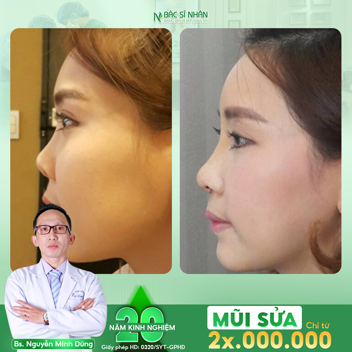 MŨI BỊ LÒI SỤN - CÓ NGUY HIỂN KHÔNG?